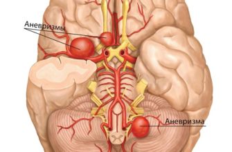 anevrizma-golovnogo-mozga-simptomy-lechenie-lechenie-mozga-headnothurt-ru-2