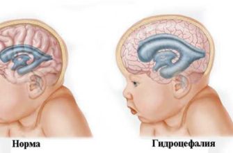 entsefalopatiya-s-gipertenzionno-gidrotsefalnym-sindromom-entsefalopatiya-headnothurt-ru-2