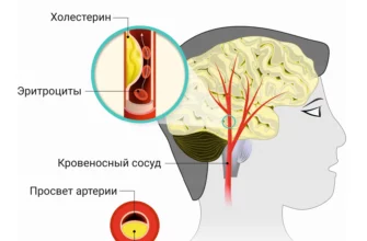 lechenie-ateroskleroza-golovnogo-mozga-narodnymi-sredstvami-lechenie-mozga-headnothurt-ru-2