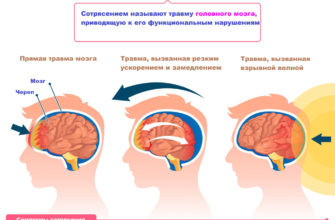 lechenie-pri-silnom-sotryasenii-mozga-lechenie-mozga-headnothurt-ru-2