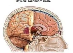 opuhol-na-kore-golovnogo-mozga-opuhol-mozga-headnothurt-ru-2