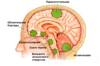 opuhol-stvola-golovnogo-mozga-u-detej-forum-opuhol-mozga-headnothurt-ru-2