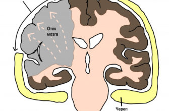 otek-golovnogo-mozga-simptomy-u-vzroslyh-lechenie-lechenie-mozga-headnothurt-ru-2