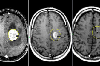 pervye-simptomy-opuholi-golovnogo-mozga-u-detej-opuhol-mozga-headnothurt-ru-2
